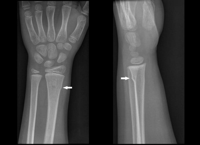 Broken Wrist (Colles Fracture): Causes, Symptoms, Diagnosis & Recovery