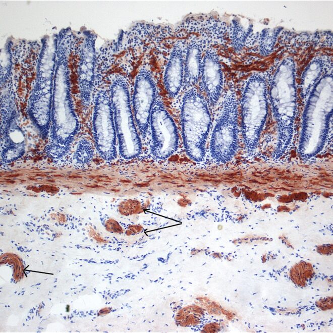 Hirschsprung’s Disease (Congenital Megacolon): Overview, Symptoms, Diagnosis & Treatment