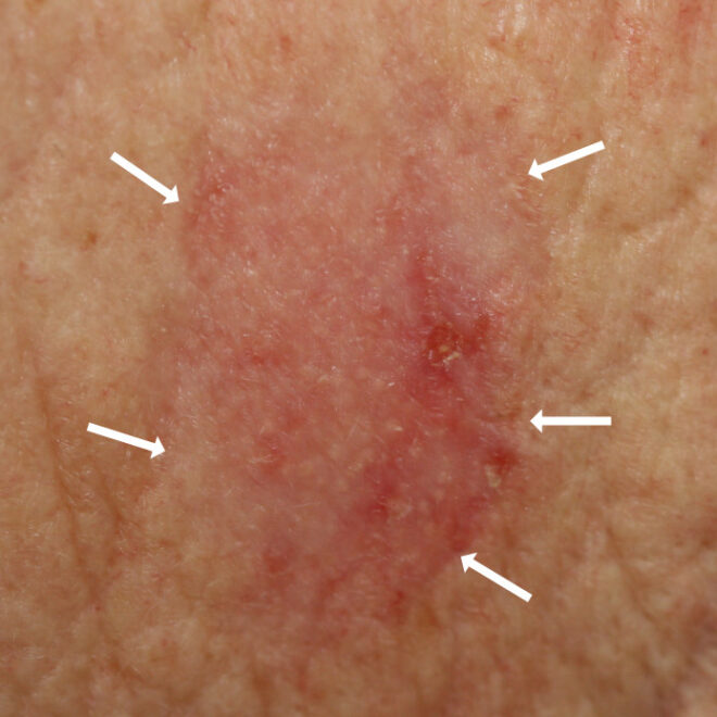 Basal Cell Skin Cancer (Basal Cell Carcinoma): Overview, Symptoms, Causes & Treatments
