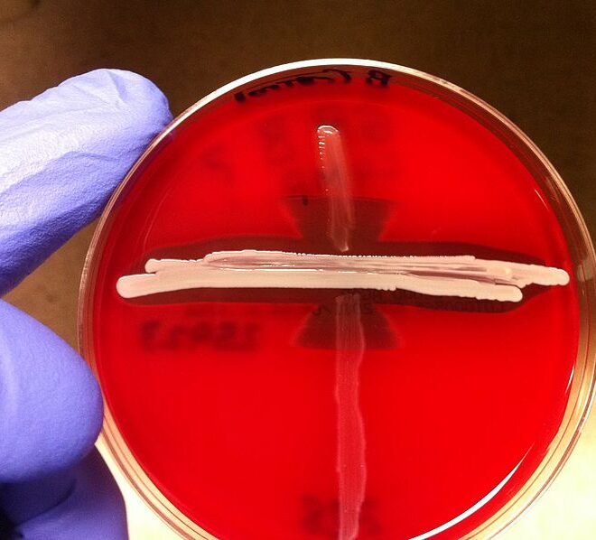 Group B Strep Infection: Causes, Symptoms, Diagnosis & Care