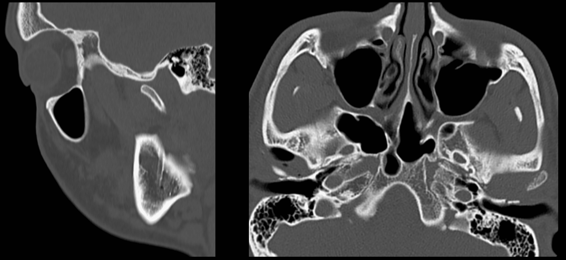 Temporomandibular Joint Dysfunction (TMJ Disorder): Causes, Symptoms, and Treatments