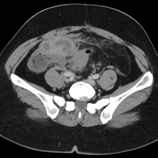 Pelvic Inflammatory Disease (PID): Causes, Symptoms, Diagnosis, and Treatment