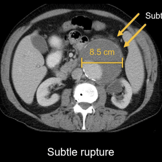 Abdominal Aortic Aneurysm (Enlarged Artery in the Abdomen)