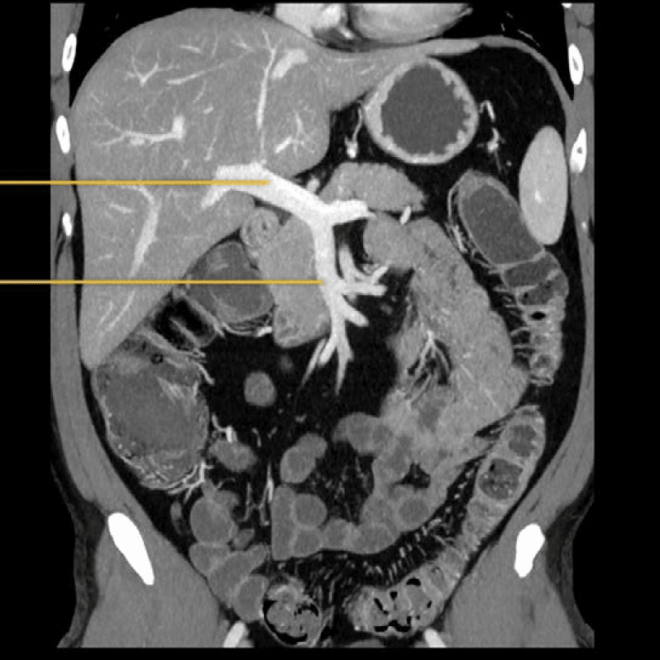 Mesenteric Ischemia: A Guide to Causes, Symptoms, Diagnosis, and Treatment