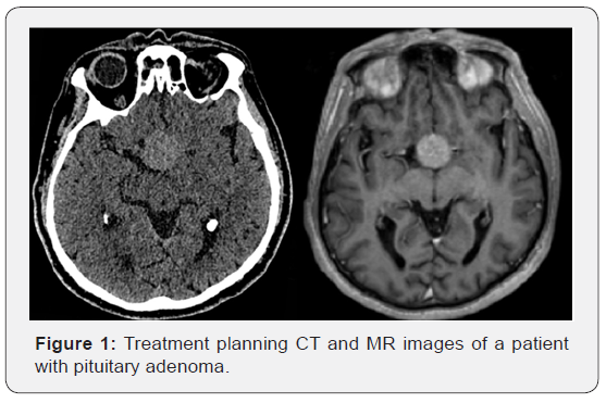 Pituitary Tumor: Overview, Types, Symptoms & Diagnosis