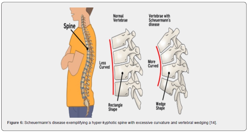Kyphosis: An Overview of the Curved Upper Back Condition (Hyperkyphosis)