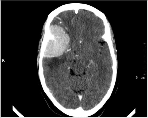 Meningioma Brain Tumor: Overview, Causes, Diagnosis, and Treatments