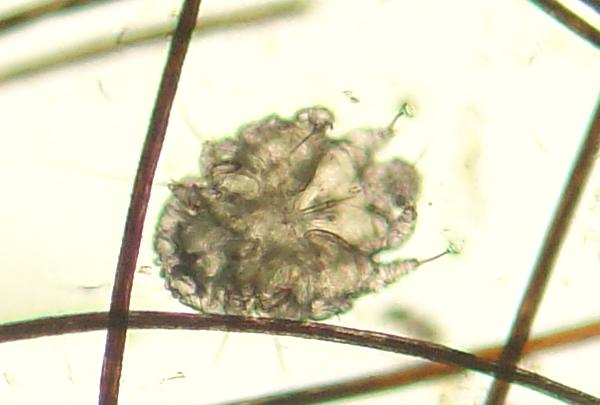 Scabies: Causes, Symptoms, Treatment, and Prevention