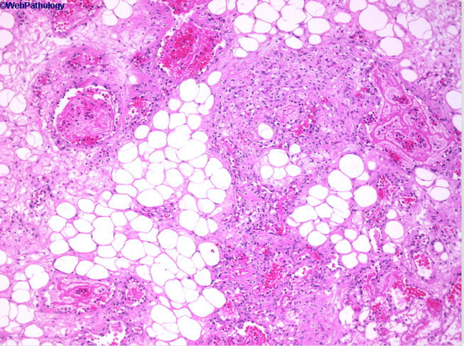 Lipoma: A Complete Guide to Fatty Lumps Under the Skin