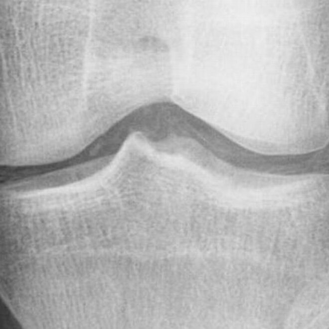 Pseudogout: Causes, Symptoms, Diagnosis, and Treatment (Calcium Pyrophosphate Deposition Disease)