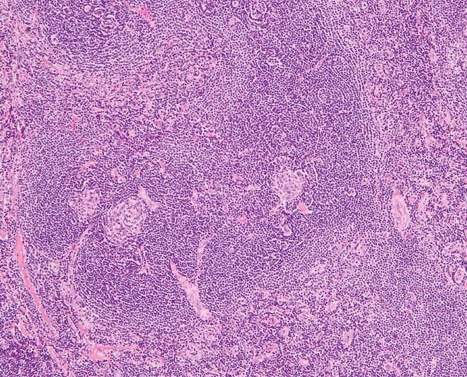 Castleman Disease: Understanding the Rare Immune Disorder (Lymphoproliferative Disorder)