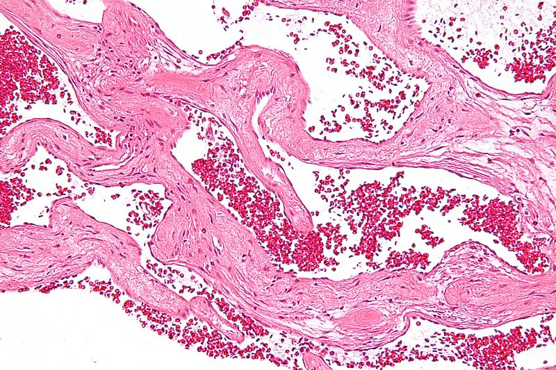 Liver Hemangioma (Benign Tumor): Overview, Causes, Diagnosis & Care