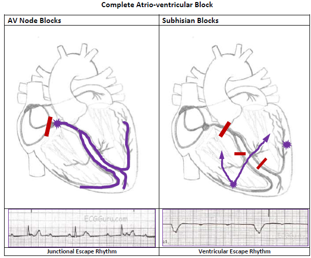 Heart Block: Understanding Its Types, Causes, and Treatments