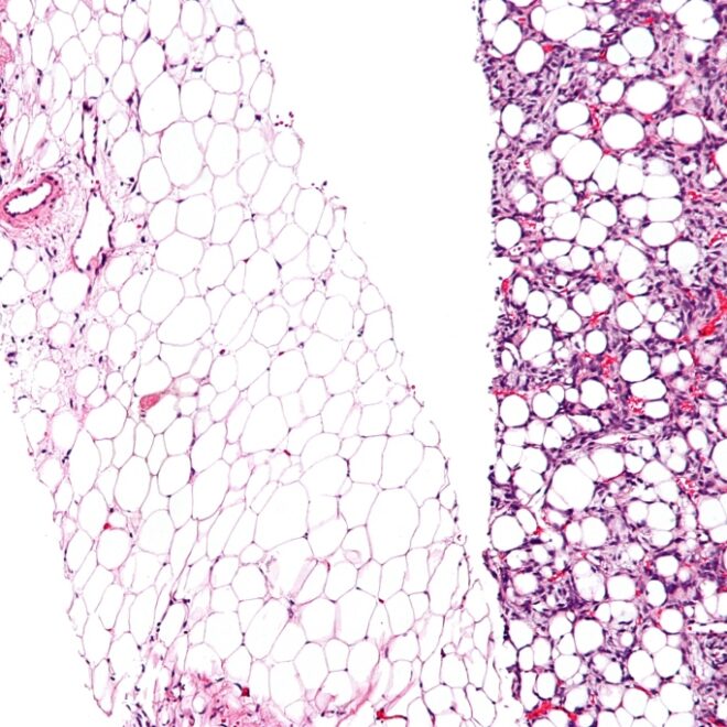 Liposarcoma: Types, Causes, Diagnosis, and Treatment Options