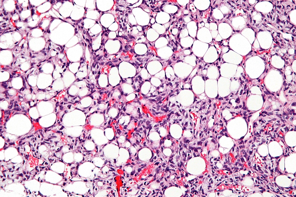 Liposarcoma: Types, Causes, Diagnosis, and Treatment Options