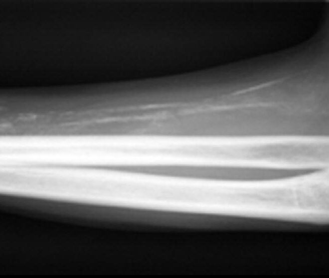 Dermatomyositis: A Detailed Overview of Symptoms, Diagnosis, and Treatment