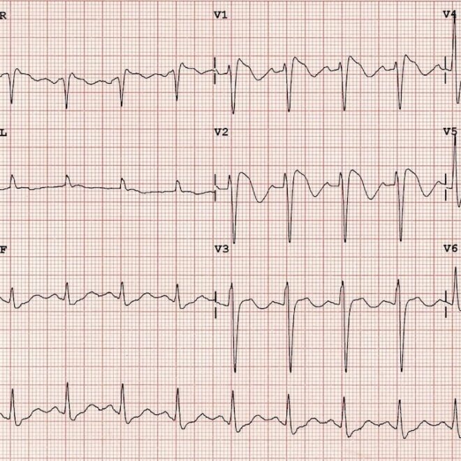 Brugada Syndrome: A Heart Rhythm Disorder Explained