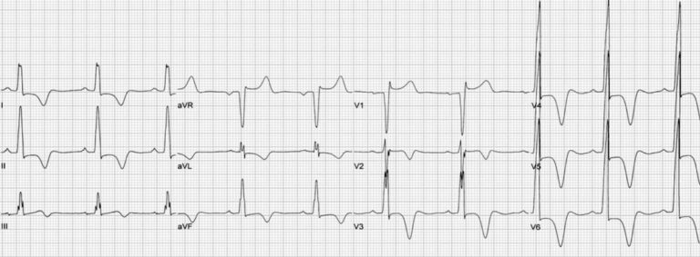 Hypertrophic Cardiomyopathy (Thick Heart Muscle Disease): Overview, Symptoms, Diagnosis & Care