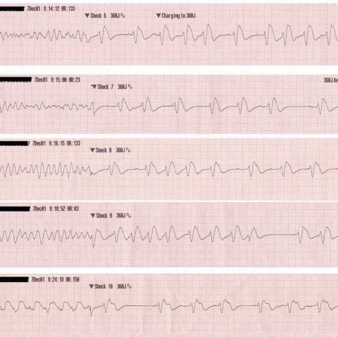 Ventricular Fibrillation: Causes, Symptoms, and Emergency Care