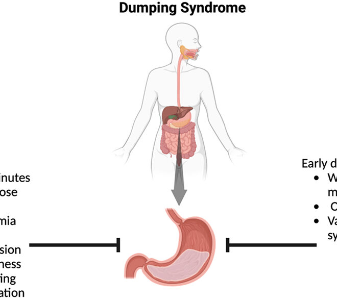 Dumping Syndrome: What It Is, Causes, Symptoms & Treatment