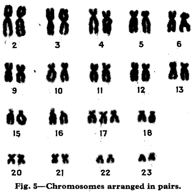 Edwards Syndrome (Trisomy 18): Overview, Causes, Symptoms & Care