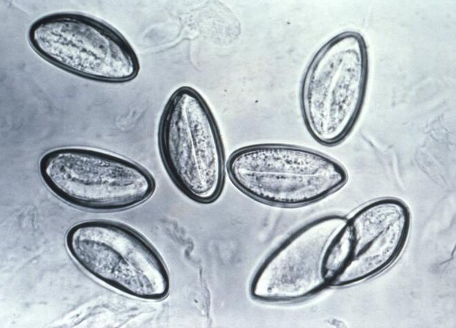 Pinworm Infection (Enterobiasis): Causes, Symptoms & Treatment