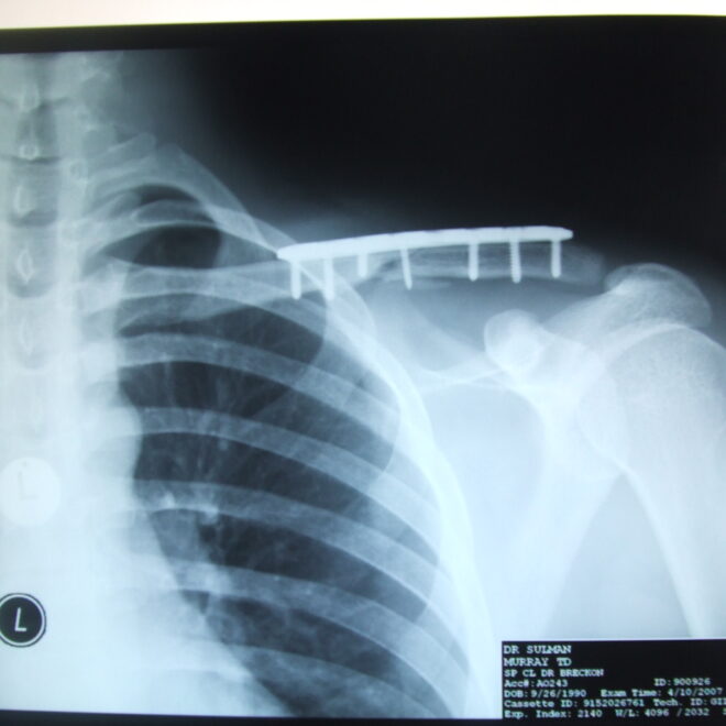 Broken Collarbone (Clavicle Fracture): Causes, Symptoms, Diagnosis & Recovery