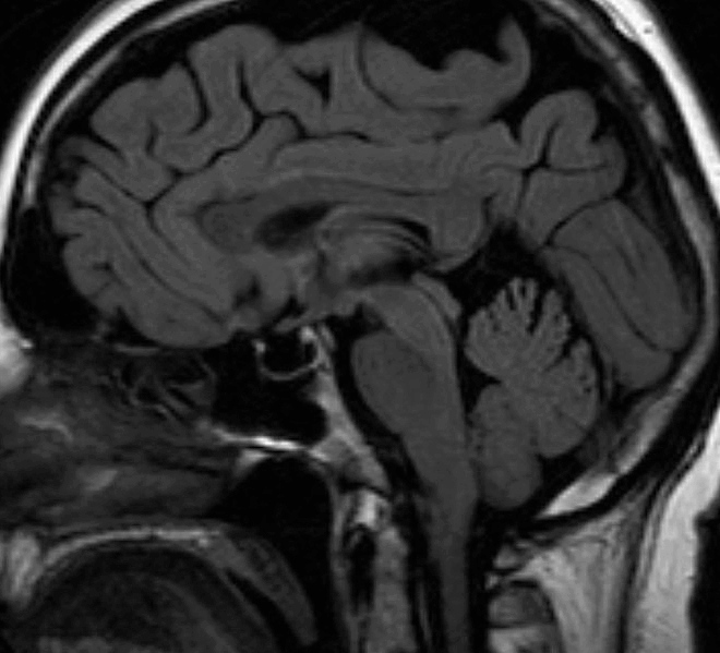 Sheehan’s Syndrome: Understanding Postpartum Pituitary Gland Damage