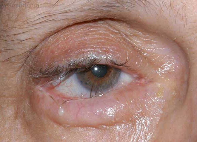 Entropion: A Comprehensive Guide to the Eyelid Condition