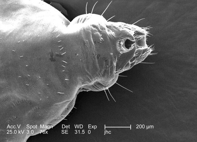 Typhus: Causes, Symptoms, Diagnosis, and Treatment (Epidemic Typhus)