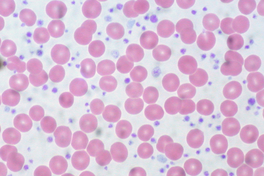 High Platelet Count (Thrombocythemia): Overview, Causes, Symptoms & Treatment