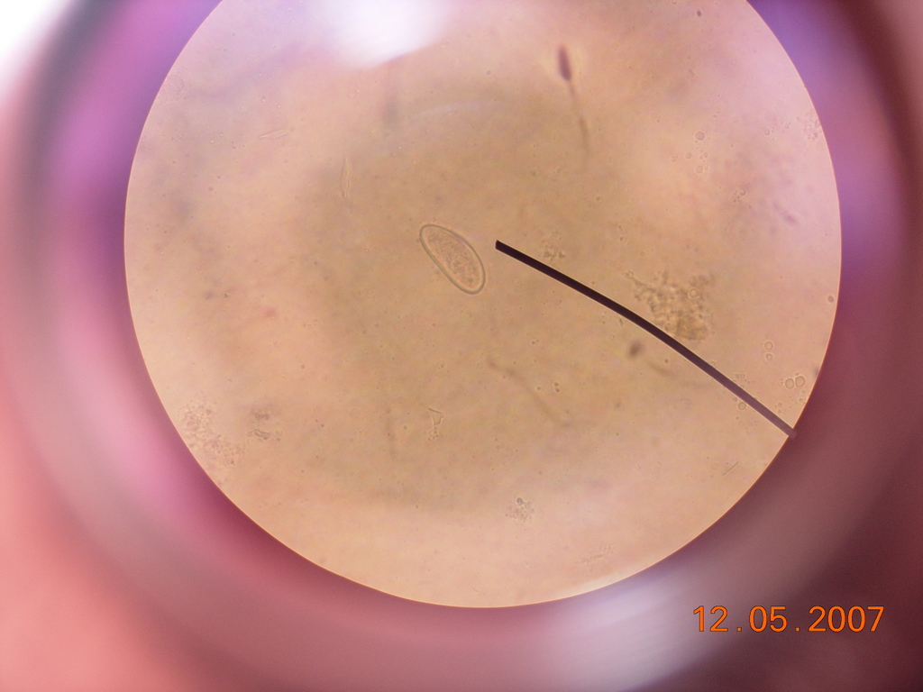 Pinworm Infection (Enterobiasis): Causes, Symptoms & Treatment