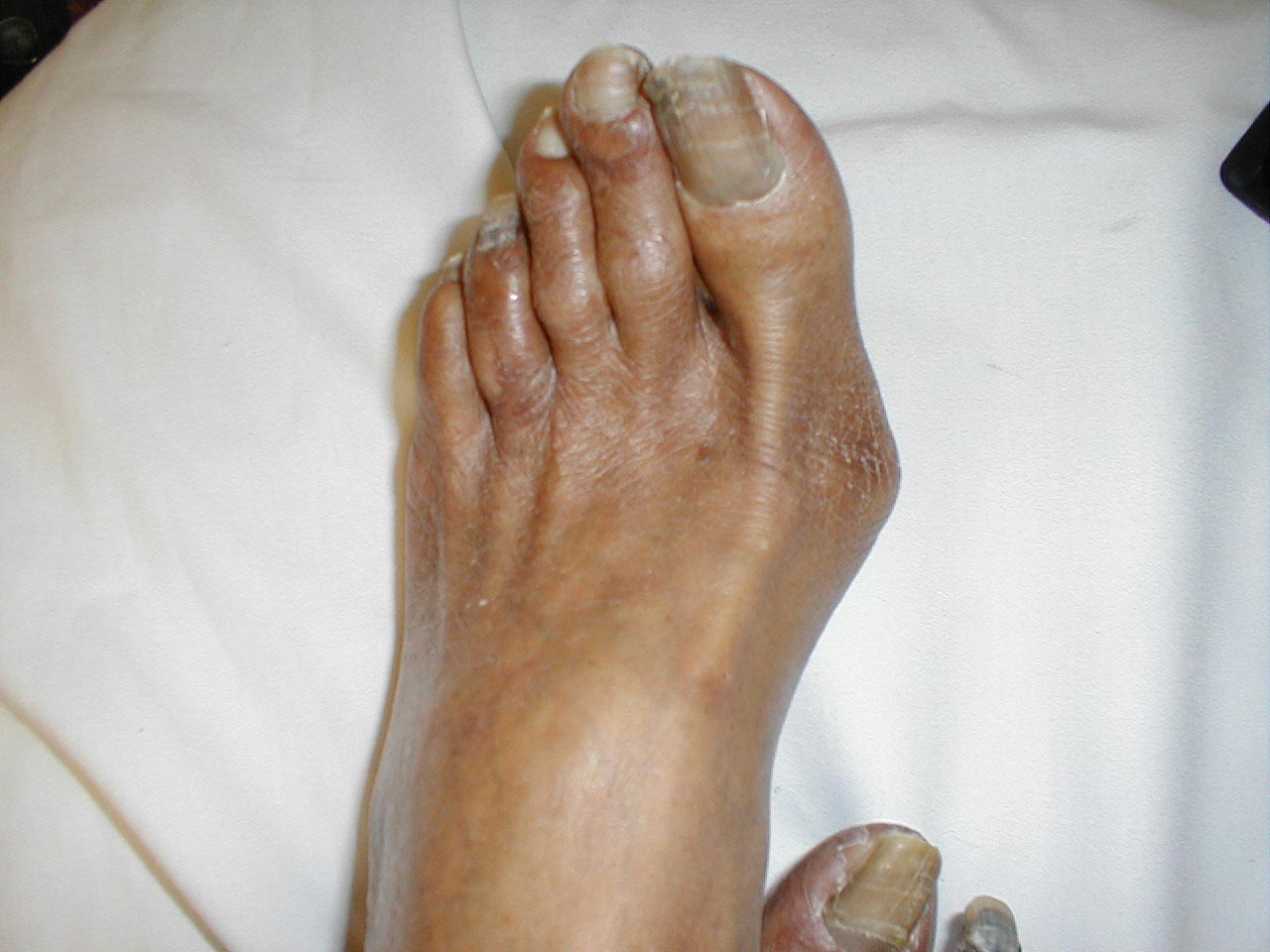 Gangrene: Types, Causes, Symptoms, and Treatments