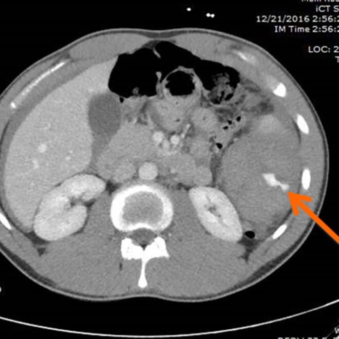 Spleen Rupture: Causes, Symptoms, Diagnosis, and Treatment