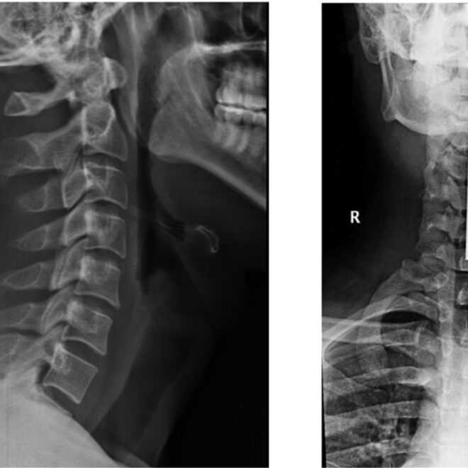 Cervical Stenosis: Understanding the Narrowing of the Neck’s Spinal Canal