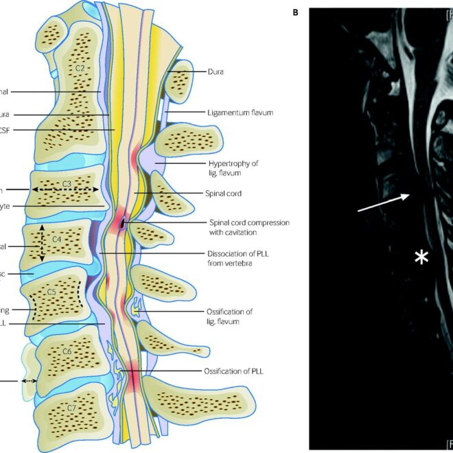 Degenerative Disc Disease: Overview, Causes, Symptoms & Care Options