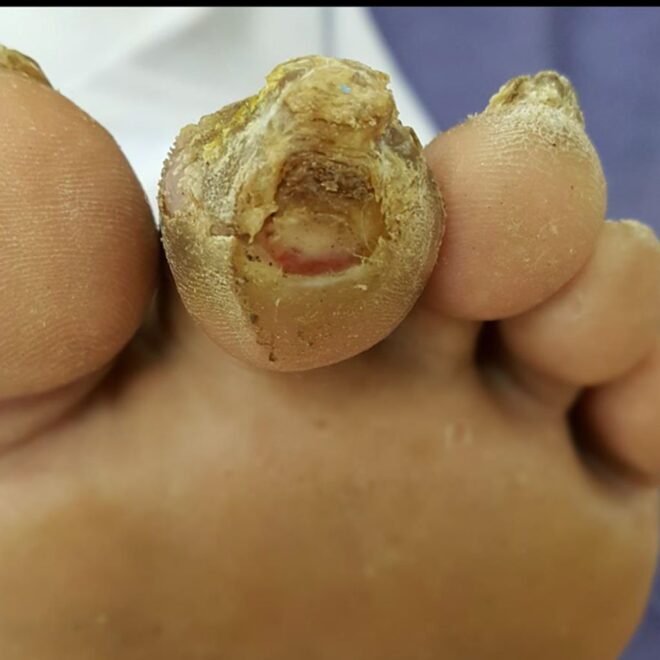 Hammer Toe: Causes, Symptoms, and Treatment Options