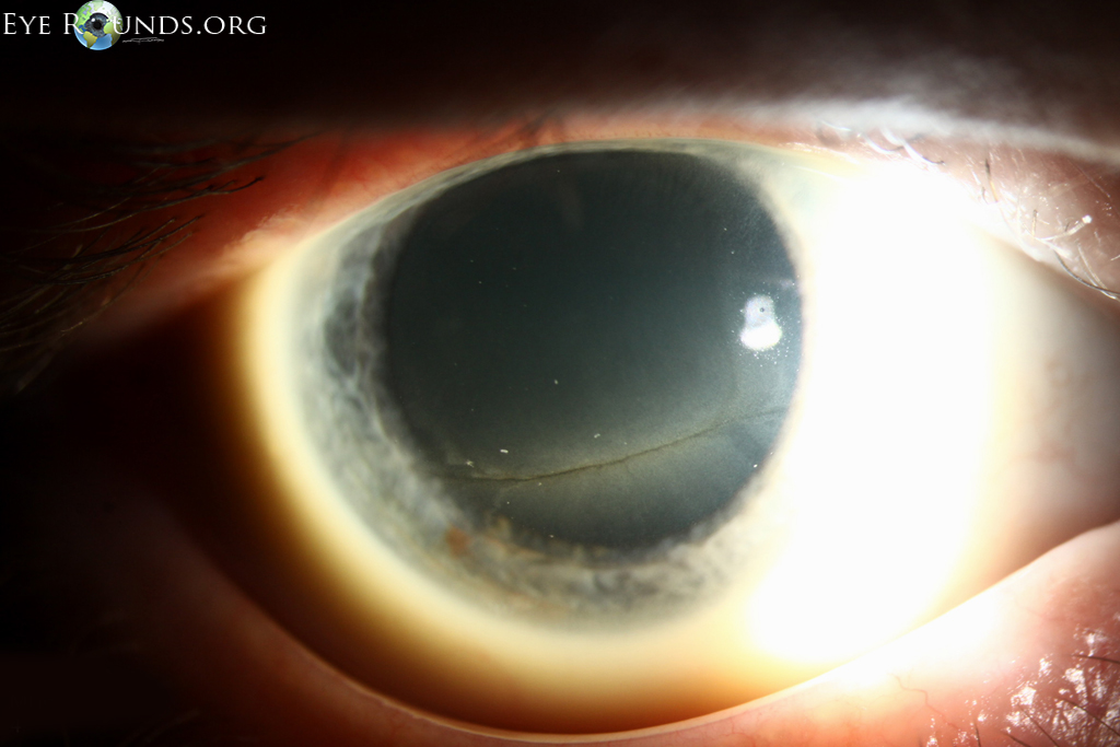 Fabry Disease: A Comprehensive Overview of Symptoms, Diagnosis, and Treatment