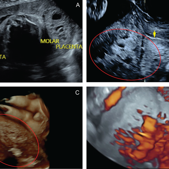 Hydatidiform Mole (Grape-like Growth in the Womb): Overview, Causes, Diagnosis, and Treatment