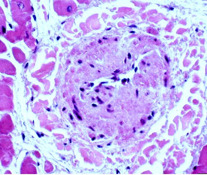 Fibromuscular Dysplasia: A Detailed Overview of the Artery Disorder