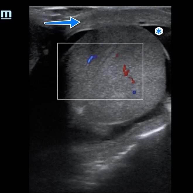 Orchitis: Causes, Symptoms, Diagnosis, and Treatment (Testicle Inflammation)