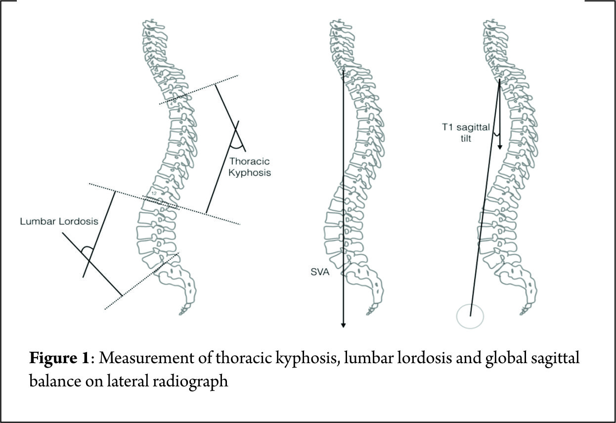 Scoliosis: Understanding the Curvature of the Spine (Scoliosis)