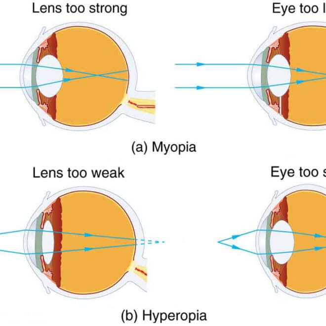 Nearsightedness (Myopia): Causes, Symptoms, and Solutions