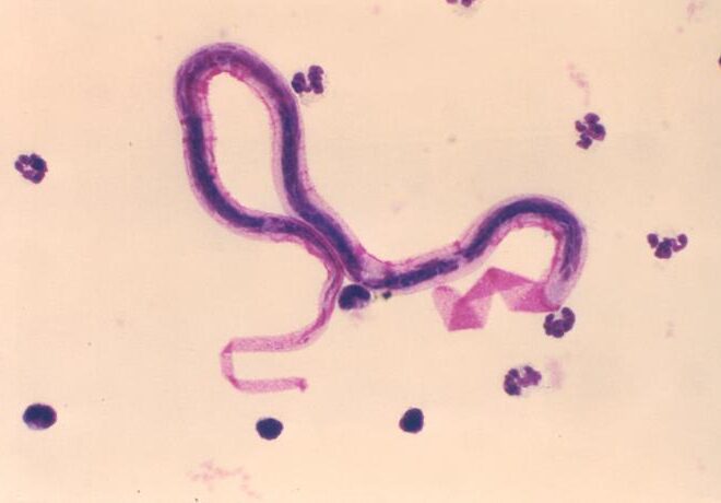 Filariasis: Understanding the Disease, Its Causes, and Effects