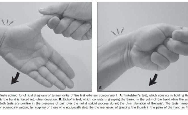 De Quervain’s Tenosynovitis: Causes, Symptoms, Diagnosis & Treatment (Thumb Tendon Swelling)