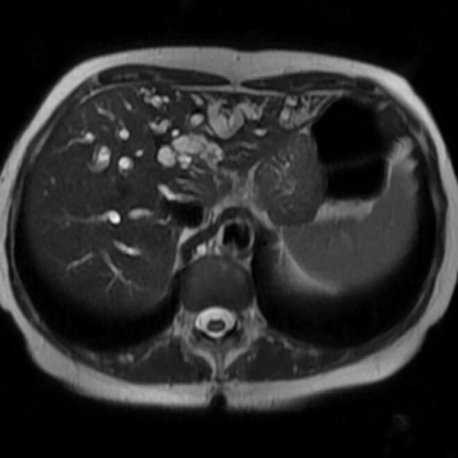 Gallbladder Cancer: Understanding the Disease, Risk Factors, and Treatments