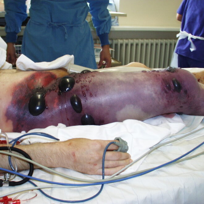 Gangrene: Types, Causes, Symptoms, and Treatments