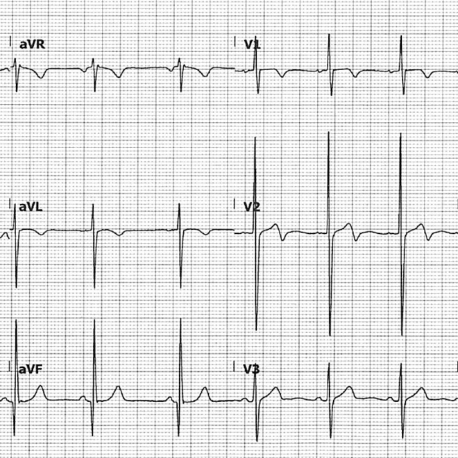 Hypertrophic Cardiomyopathy (Thick Heart Muscle Disease): Overview, Symptoms, Diagnosis & Care