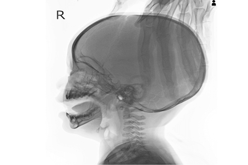Hydrocephalus: Causes, Symptoms, and Treatments