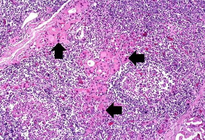 Hashimoto’s Thyroiditis (Chronic Lymphocytic Thyroiditis): Overview, Symptoms, Diagnosis & Care